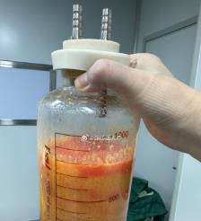 柳林水动力吸脂手术要做多久？